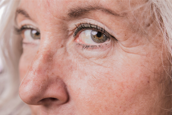 Crows Feet