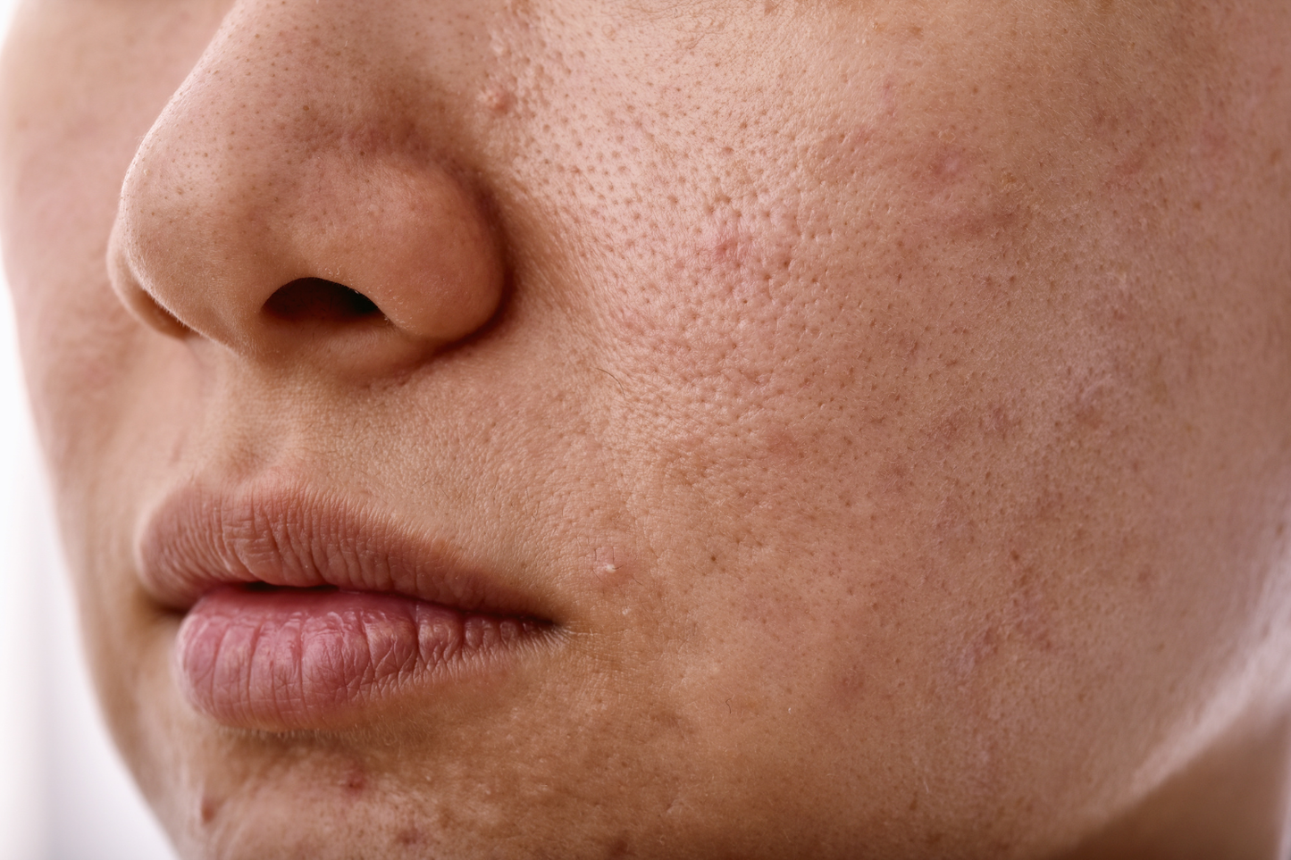 How Long Does Skin Purging Last