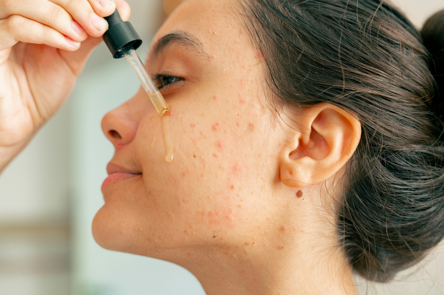 Is Hyaluronic Acid Good For Acne