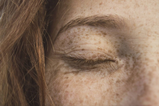 Sun Spots Vs Freckles: How To Spot The Differences